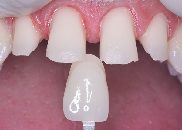 Smile Design and Treatment Planning
